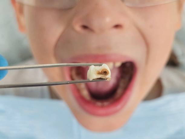 Best Emergency Treatment for Toothache in Rolling Fork, MS